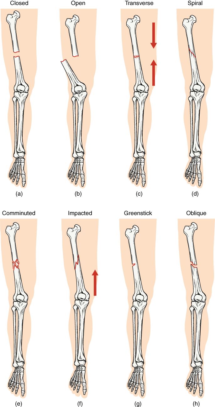 Types of bone fractures reference figure