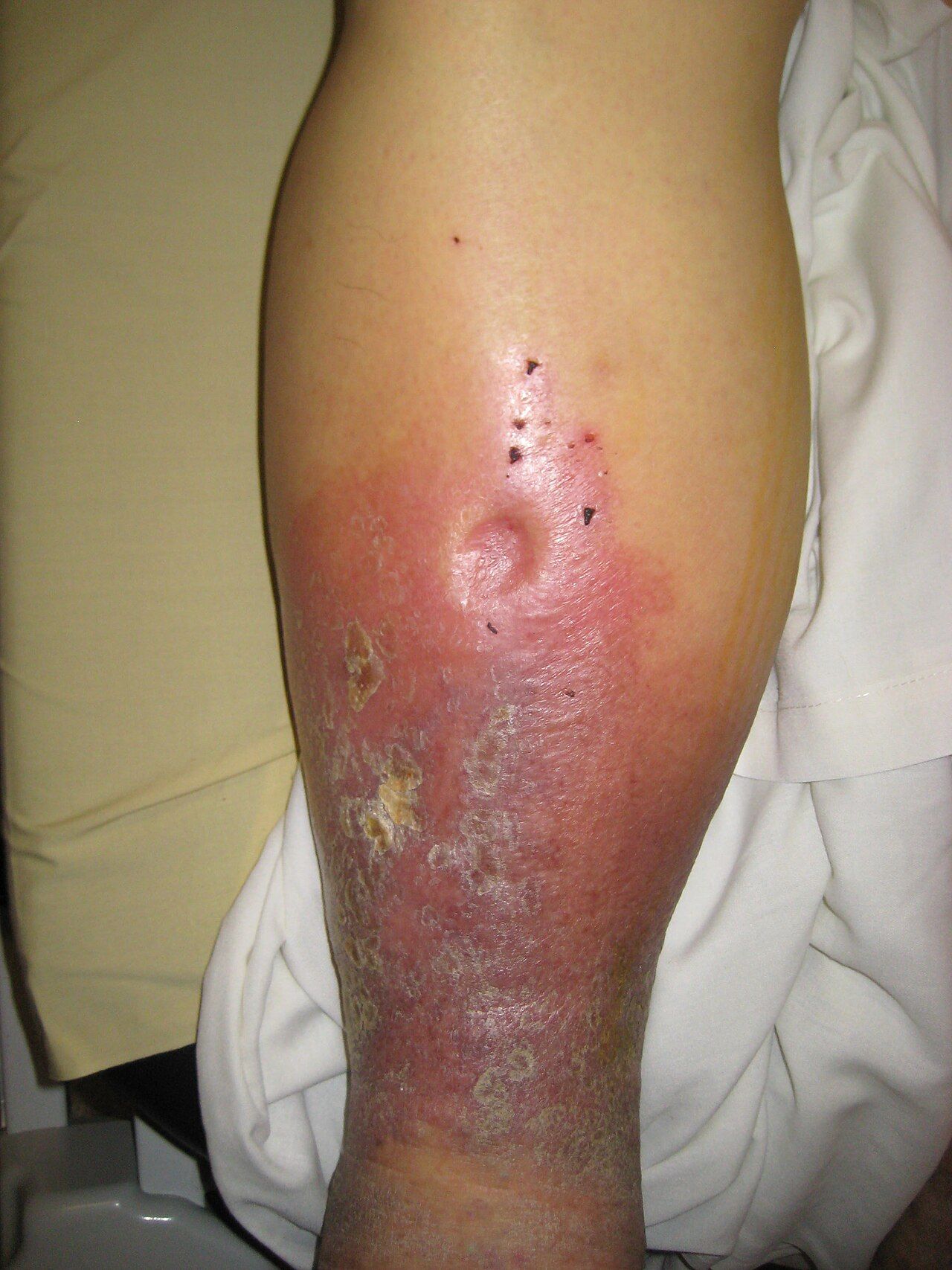 Pitting edema demonstrated over the tibia, graded by pit depth and rebound time.