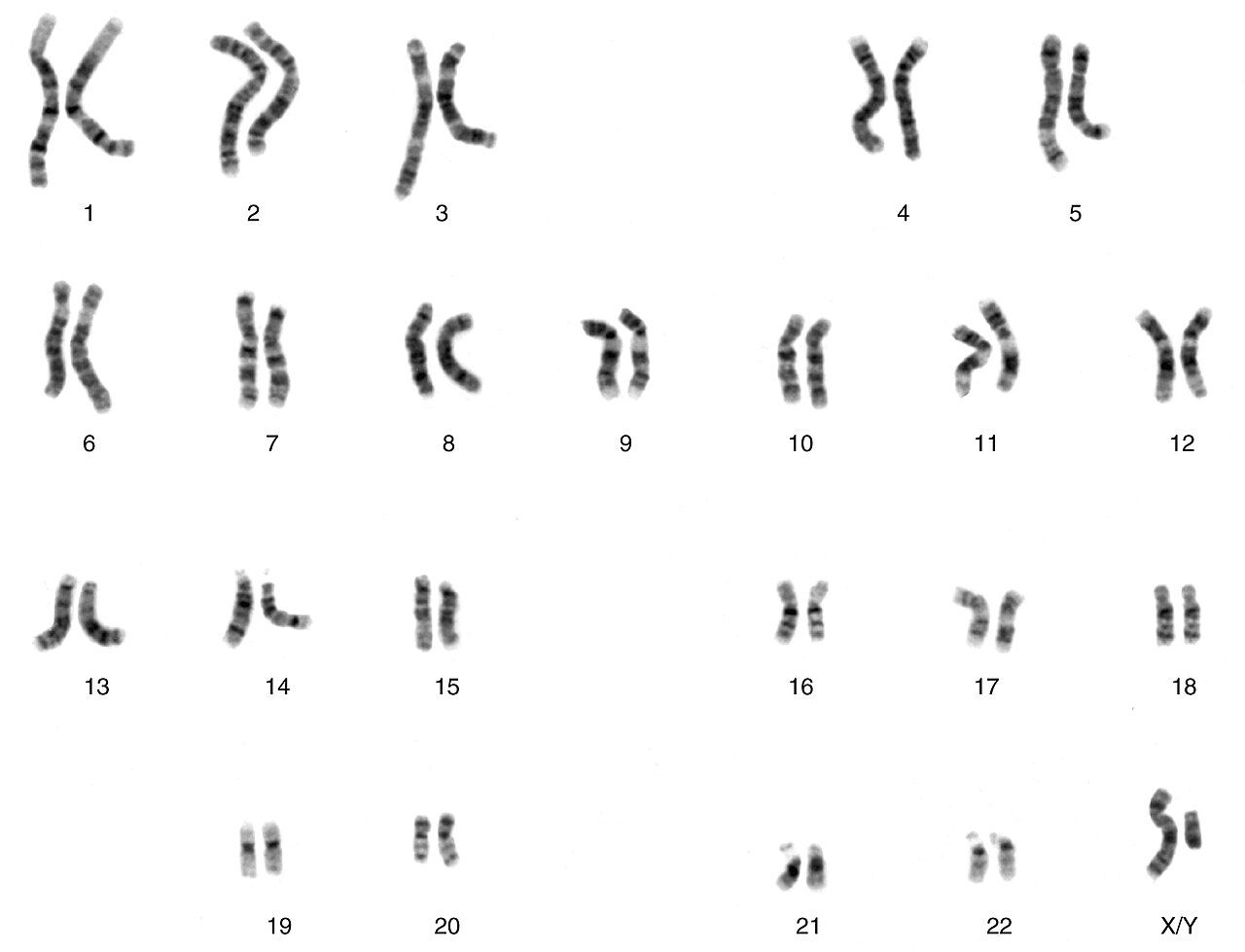 A human karyotype showing 23 pairs of chromosomes, including the sex chromosomes