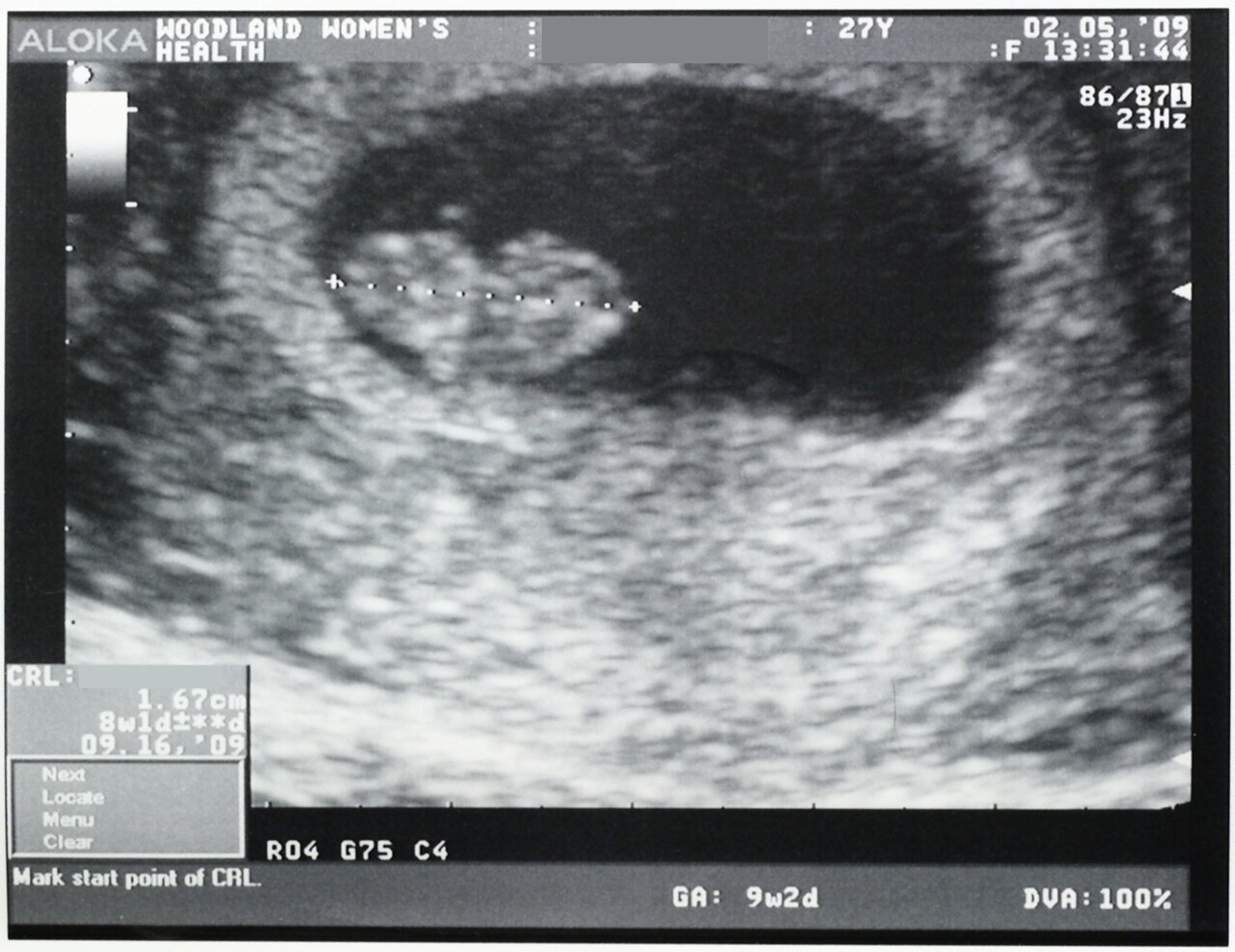 Ultrasound visualisation of an intrauterine gestational sac and fetal pole is a positive sign of pregnancy and the most accurate method of dating.