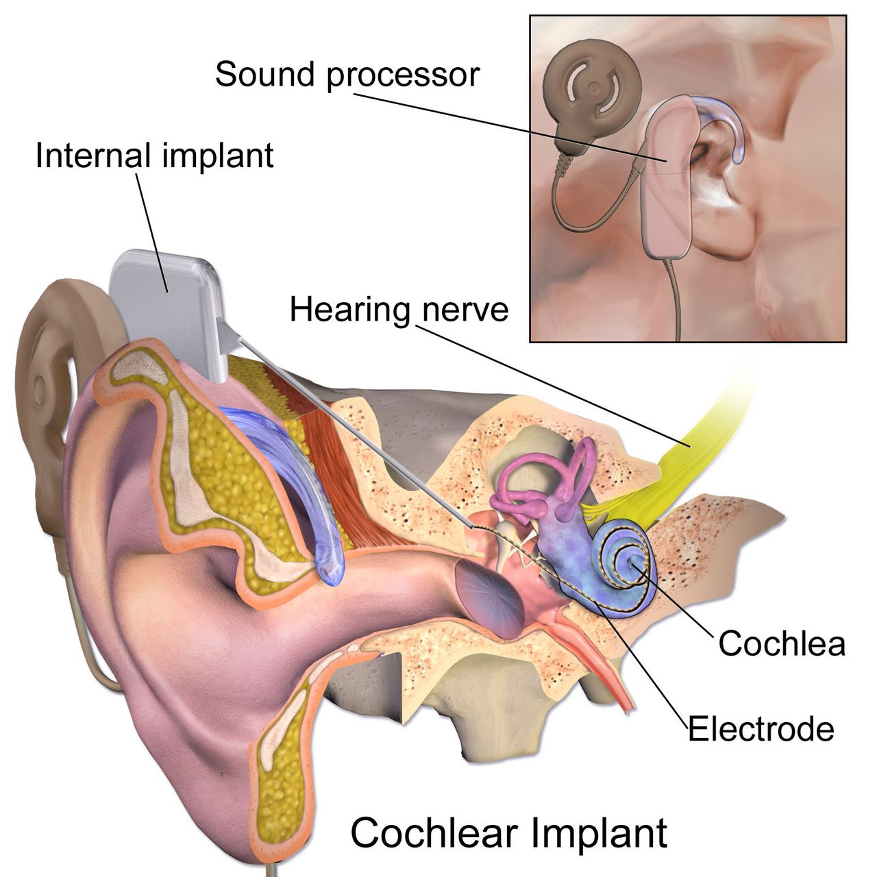 Diagram comparing a normally implanted placenta with placenta praevia covering the internal cervical os and with premature separation of the placenta from the uterine wall
