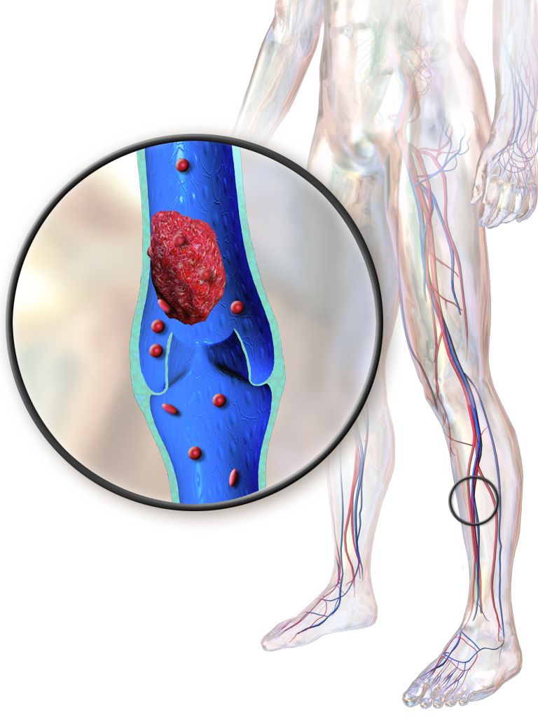 Diagram of a deep vein thrombosis in the leg with a fragment embolising to the pulmonary arteries