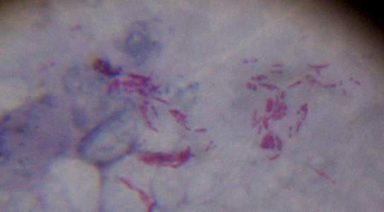 Acid-fast bacilli on Ziehl&ndash;Neelsen stain &mdash; the waxy mycolic-acid cell wall that retains carbolfuchsin is the same wall that makes tuberculosis slow to grow and slow to treat. CDC / Dr. Geo
