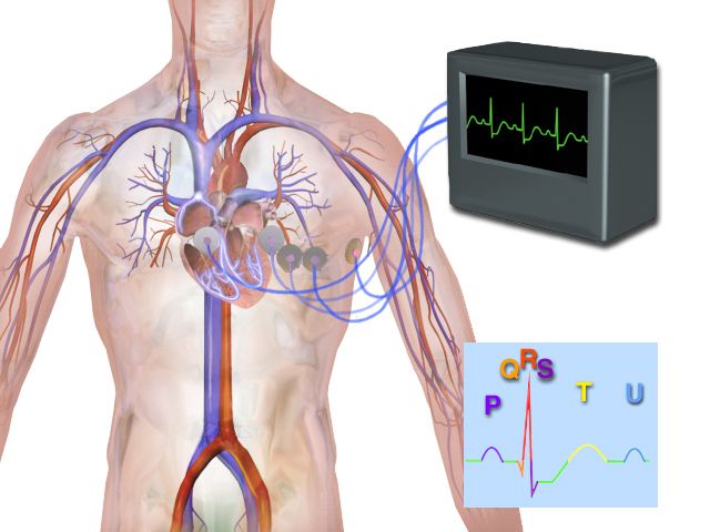 Twelve-lead electrocardiogram tracing demonstrating ST-segment elevation in the anterior precordial leads consistent with acute anterior myocardial infarction