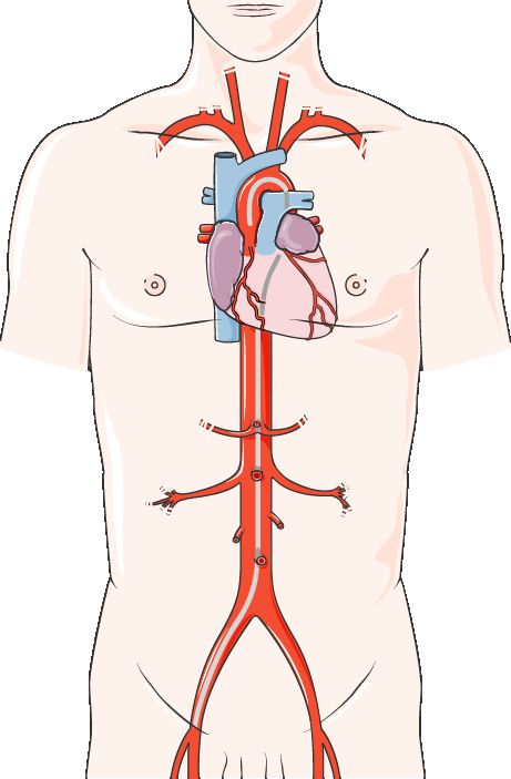 Illustration of percutaneous coronary intervention showing a balloon catheter and expandable metal stent restoring the lumen of a narrowed coronary artery