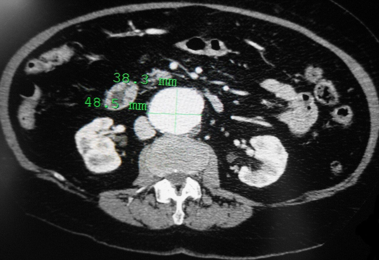 An abdominal aortic aneurysm on computed tomography: silent until it is not, and a rupture is a surgical emergency.