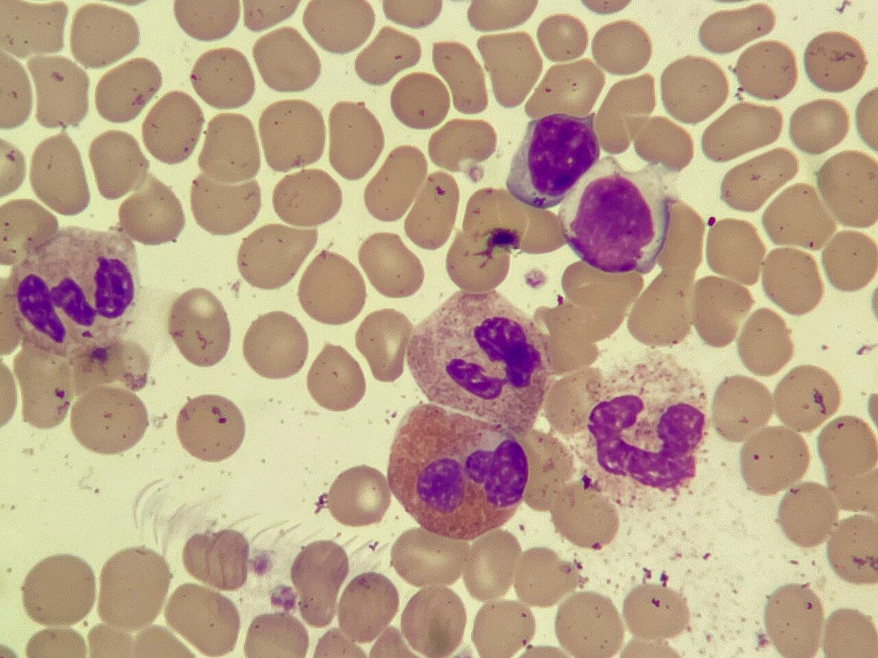 A peripheral smear tells you the shape of the problem long before the patient tells you the story.