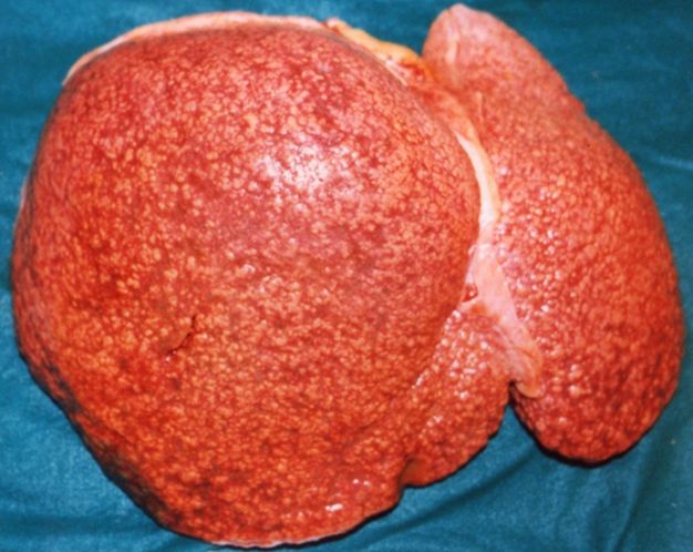 In cirrhosis, regenerative nodules and fibrous bands replace normal parenchyma, obstructing portal blood flow and driving every complication in this section.