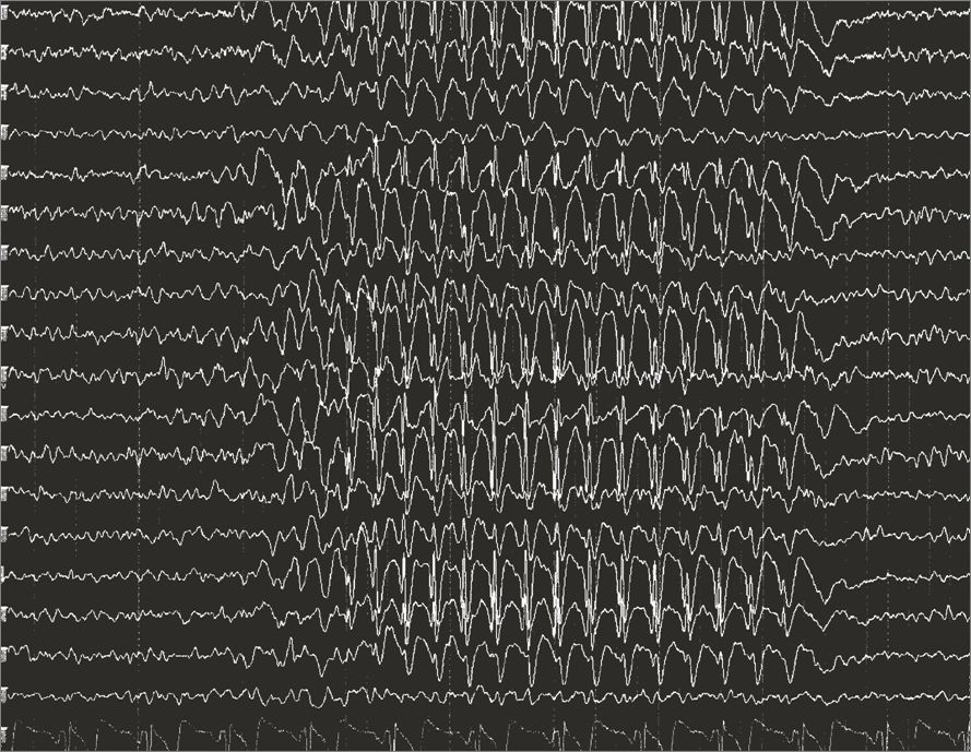 Generalized spike-and-wave discharges on EEG &mdash; the electrical signature of the hypersynchronous firing that a seizure is, recorded from the scalp while the patient appears merely to be staring.