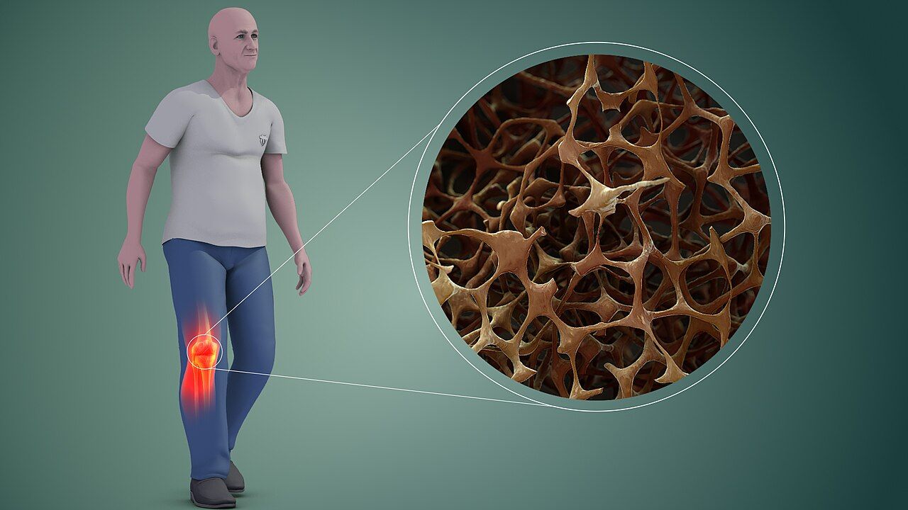 Osteoporotic bone has normal mineral composition but too little of it &mdash; trabeculae thin, perforate and lose the cross-struts that resist load.