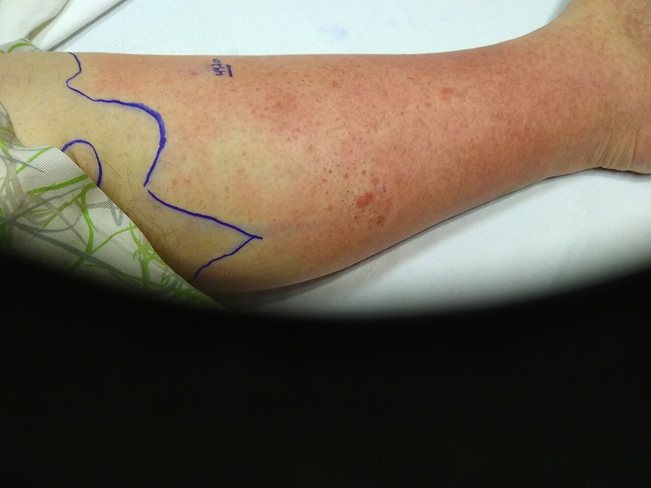Cellulitis of the lower leg with the advancing margin outlined in ink &mdash; the cheapest and most useful serial assessment on the unit.