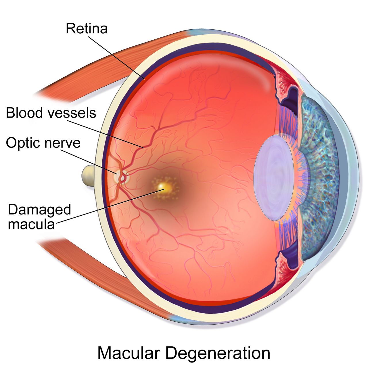 Fundus photograph montage showing a normal retina alongside diabetic retinopathy with microaneurysms and exudates and macular degeneration with drusen