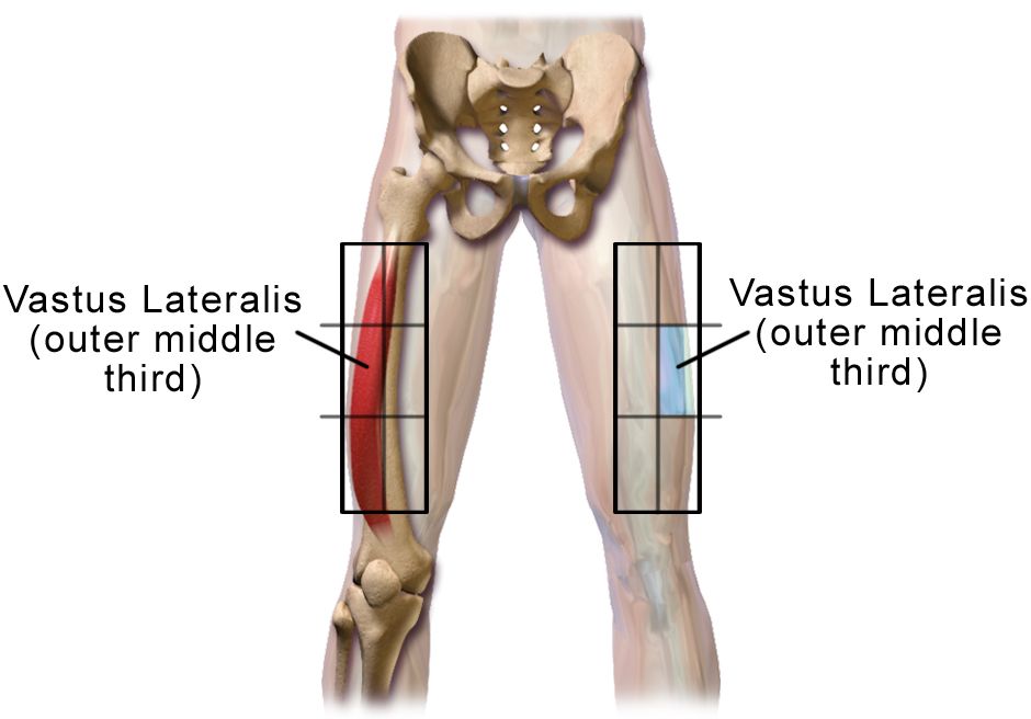 Epinephrine autoinjector held against the outer thigh, the anterolateral vastus lateralis site used for intramuscular injection in anaphylaxis