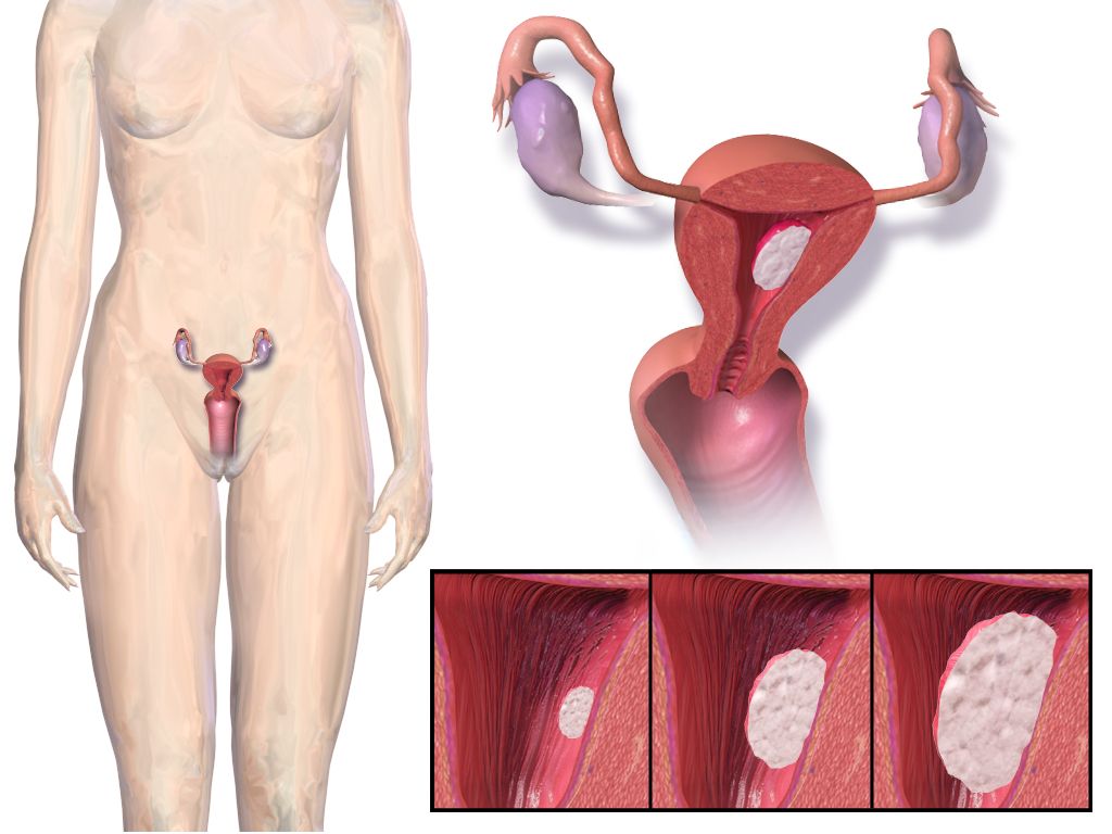 Illustration of a uterus showing submucosal, intramural and subserosal leiomyomas distorting the endometrial cavity