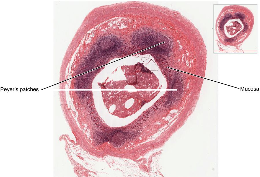 Mammogram images of a breast demonstrating a spiculated dense mass with associated microcalcifications