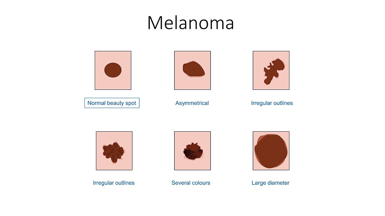 Clinical photograph of an asymmetric pigmented skin lesion with irregular border and variable coloration, consistent with malignant melanoma