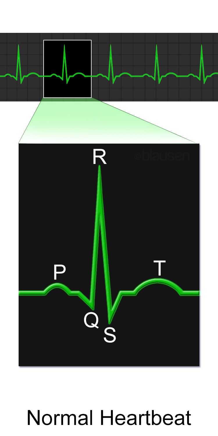 A normal twelve-lead electrocardiogram tracing with the P wave, QRS complex, T wave, PR interval and ST segment labeled on a single beat