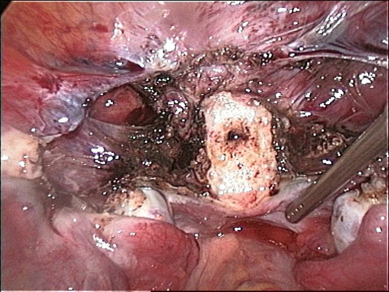 Pelvic laparoscopy &mdash; lapar/o abdomen + -scopy process of viewing &mdash; now the standard approach for tubal, ovarian and many uterine operations.