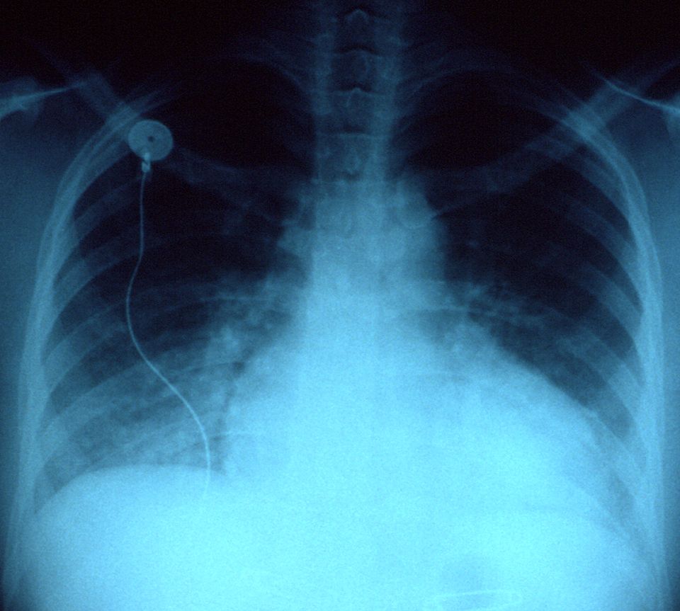 Heart failure reference figure