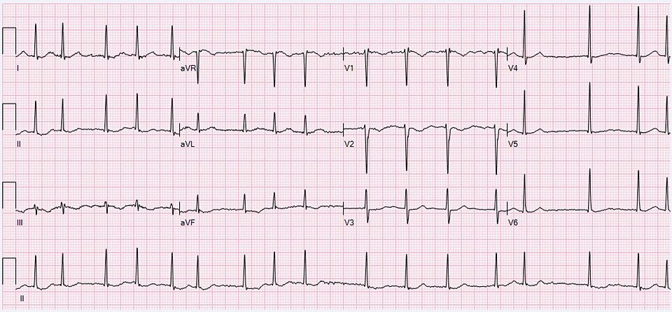 EKG & arrhythmias reference figure