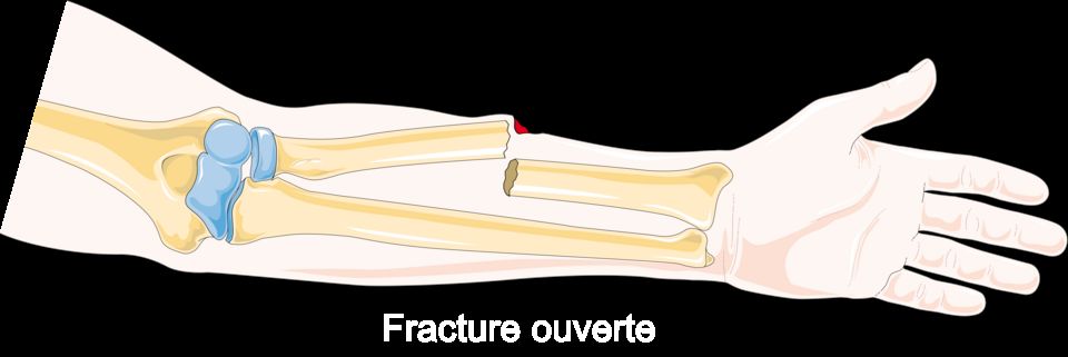 Fractures reference figure