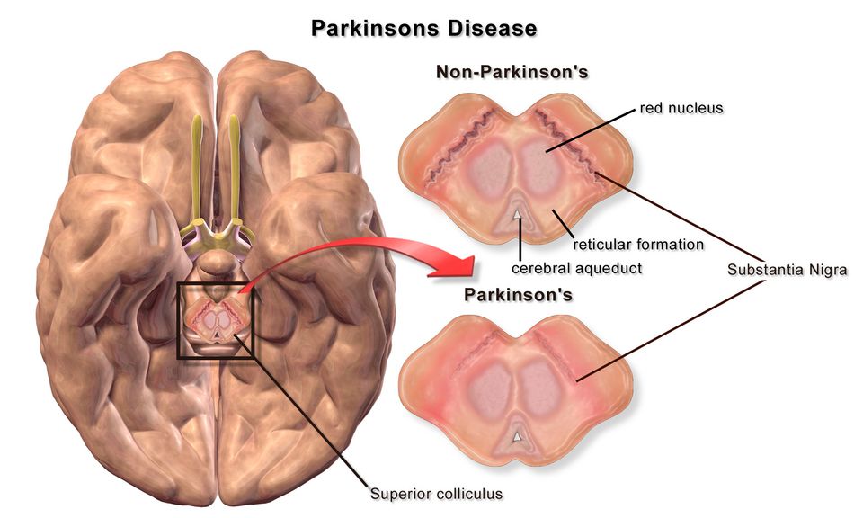 Neurodegeneration reference figure
