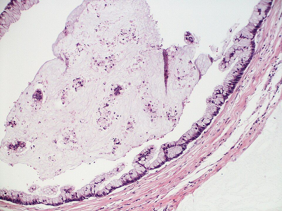 Benign vs malignant reference figure