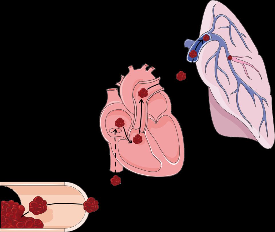 Pulmonary embolism reference figure