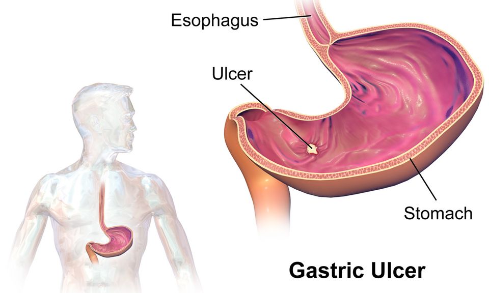 Reference figure for GERD and ulcers
