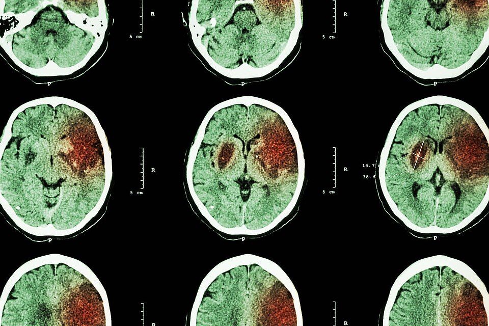 Reference figure for stroke