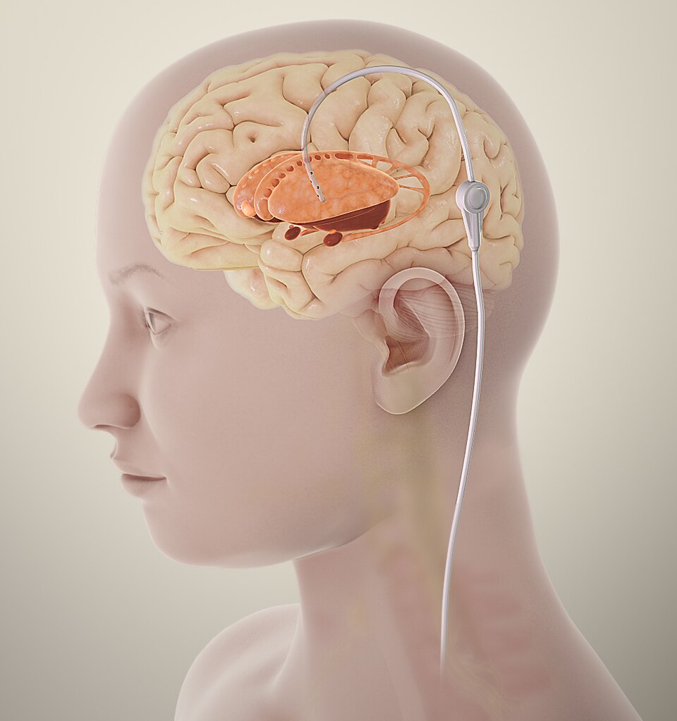 Reference figure for raised intracranial pressure