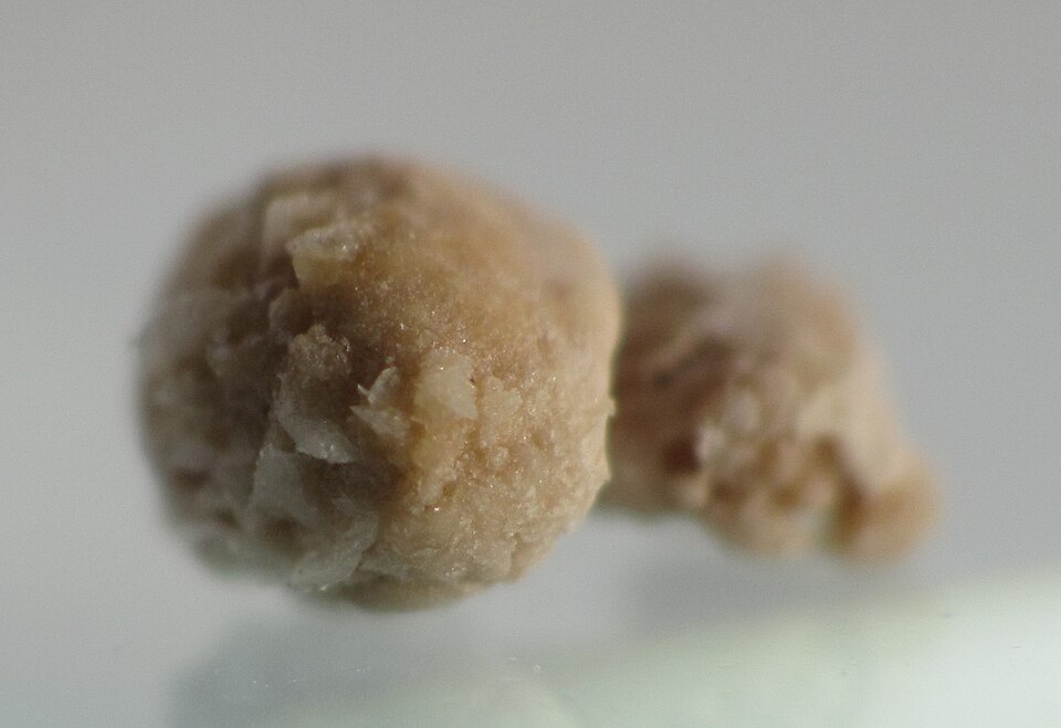 Kidney stones reference figure