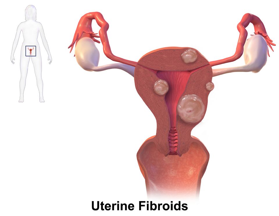 Diagram of the female reproductive organs and where common disorders occur