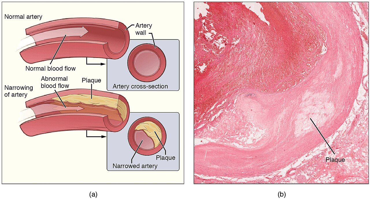 Atherosclerosis reference figure showing plaque narrowing an artery