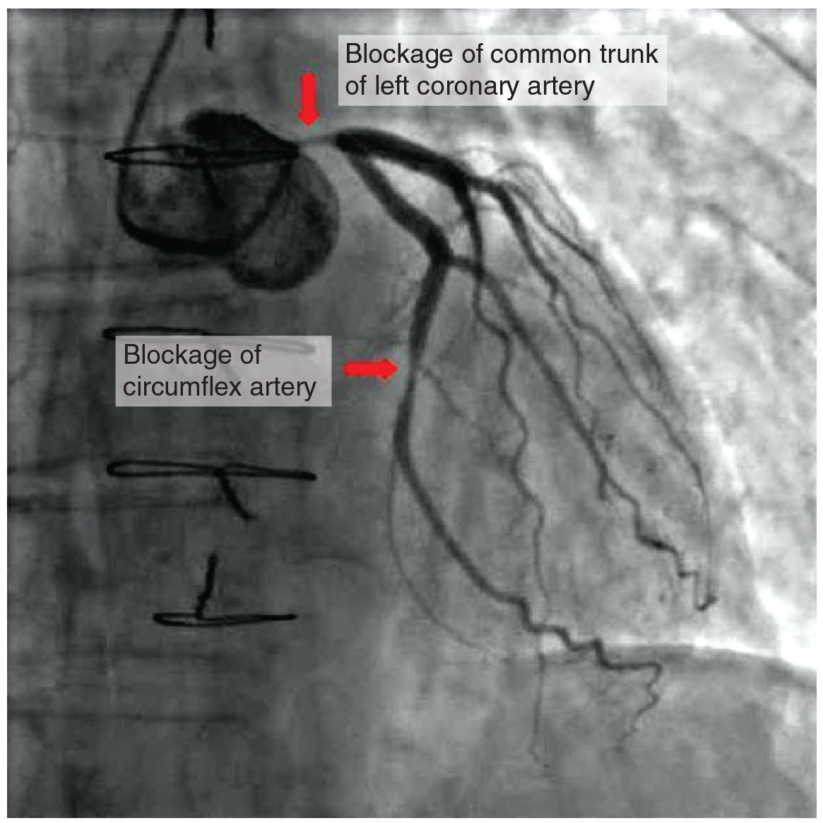 Occluded coronary arteries reference figure