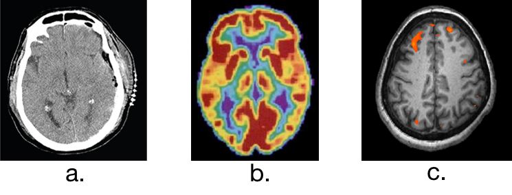 CT, PET, and functional MRI brain scans used as research tools in psychology
