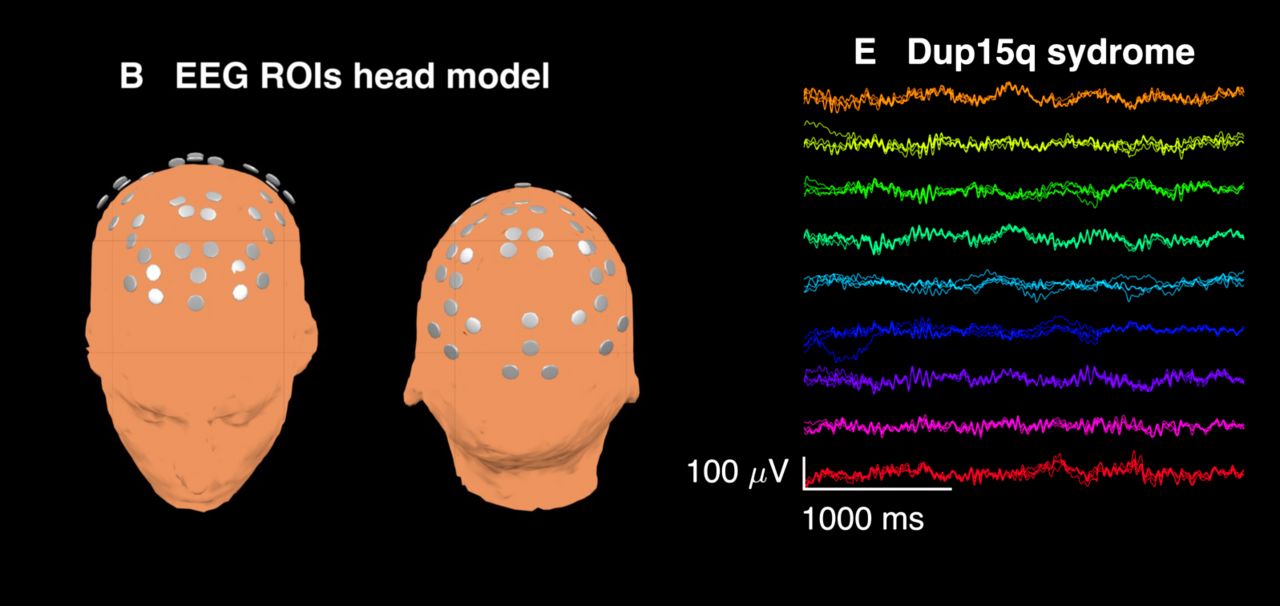 An electroencephalogram (EEG) trace of brain electrical activity